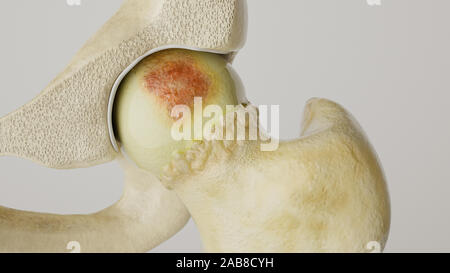 Stronger artheritis on the hip joint - high degree of detail - 3D Rendering Stock Photo