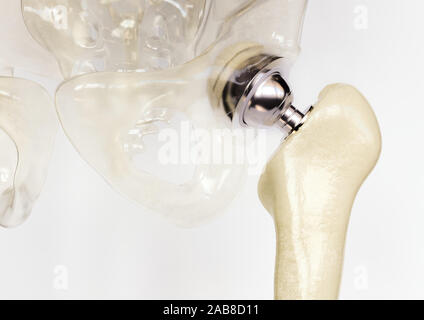 Artificial hip joint after severe osteoarthritis - 3D Rendering Stock Photo