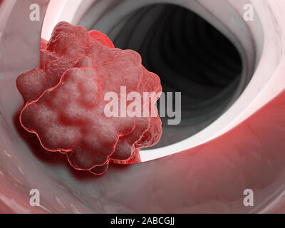3d rendered medically accurate illustration of a tumor in the colon Stock Photo