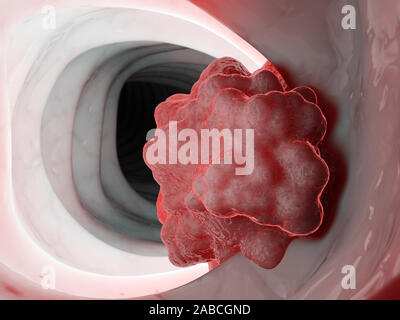 3d rendered medically accurate illustration of a tumor in the colon Stock Photo