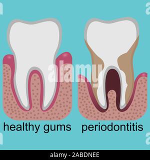 Difference between healthy gums and gums with periodontitis Stock Vector