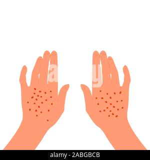 Red rash on the back of the female hands. Skin illness, allergy, inflammation. Isolated on white background. Flat style stock vector. Stock Vector