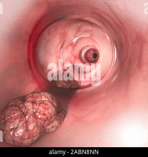 Internal view of the intestinal walls. Colorectal cancer (CRC), bowel cancer, colon cancer, or rectal cancer. Abnormal growth of cells Stock Photo