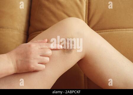 Woman points to a bruise on her leg against the couch. Stock Photo