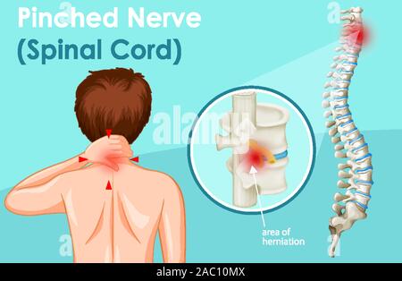 Diagram showing pinched nerve in human illustration Stock Vector