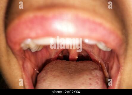 Woman with open mouth. Zooming closeup view of plaques with pus on tonsils gland in both sides. Stock Photo