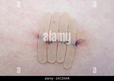 close-up of human skin with suture and wound closure strips or surgical tape after mole or melanoma biopsy Stock Photo