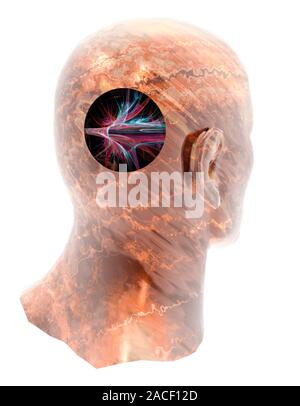 Stroke. Conceptual computer artwork of a stroke, showing a cut-away of a human head and a blood vessel bursting in the brain. A stroke is also known a Stock Photo