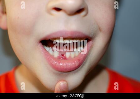 The boy's milk tooth fell out. A satisfied child holds a tooth in his