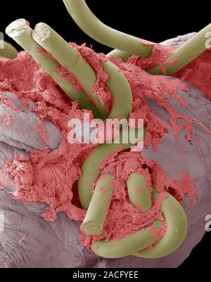 Intestinal suture repair. Coloured scanning electron micrograph (SEM) of a suture repair made in the intestines using surgical thread. Such threads ar Stock Photo