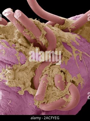 Intestinal suture repair. Coloured scanning electron micrograph (SEM) of a suture repair made in the intestines using surgical thread. Such threads ar Stock Photo