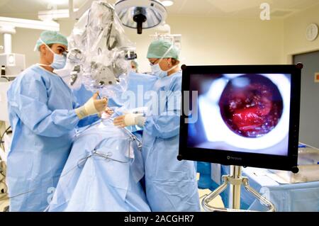 Slipped disc microendoscopy surgery. Surgeons performing an operation on a herniated (slipped) intervertebral disc using microendoscopic discectomy (M Stock Photo