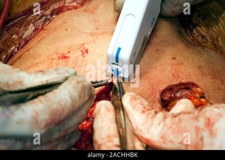 Bowel cancer surgery. Close-up of surgeons using a stapling tool to close up a patient's abdomen following bowel cancer surgery. The surgeons had perf Stock Photo