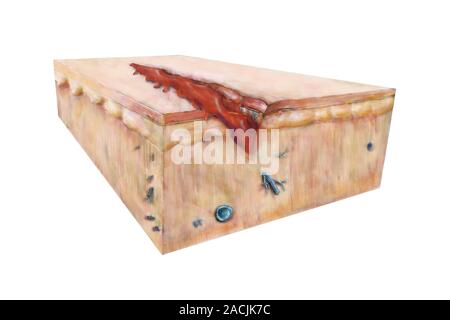 Wound healing. Artwork 3 of 4 showing wound healing. A scab (dark red) has formed over most of the wound. The scab consists of layers of keratinocytes Stock Photo