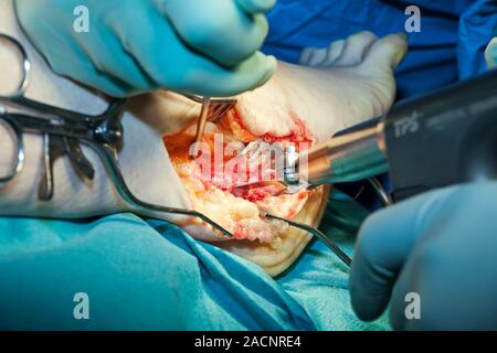 Ankle surgery. Close-up of surgical tools being used to dissect tissue from a patient's ankle. The tool at right is a bone saw, with retractors being Stock Photo