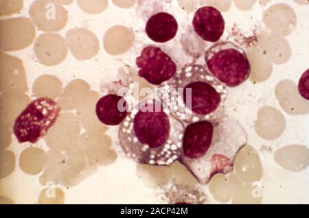 Lymphoplasmacytic lymphoma. Light micrograph of a mixture of lymphocytes and plasma cells with inclusions, from bone marrow, in a case of lymphoplasma Stock Photo