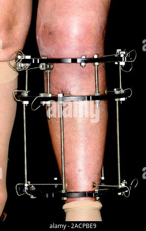 External fixator (Llizarov or sequoia frame) fitted around the leg in a 52 year old female patient to treat a fractured (broken) tibia bone after a fa Stock Photo