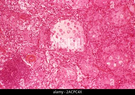 Gaucher's disease. Light micrograph of a section through the spleen of a patient with Gaucher's disease. This is an inherited metabolic disorder in wh Stock Photo