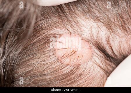 Melanocytic naevus (mole) of the scalp. Close-up of a mole (naevus) on the scalp of a 56-year-old female patient. This is a benign (non-cancerous) mel Stock Photo - Alamy Melanocytic naevus (mole) of the scalp. Close-up of a mole (naevus) on the scalp of a 56-year-old female patient. This is a benign (non-cancerous) mel Stock Photo - Alamy