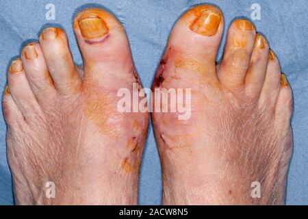 Feet after hallux rigidus surgery. Close-up of the feet of a 71-year-old female patient 10 days after surgery to treat stiff big toes (hallux rigidus) Stock Photo