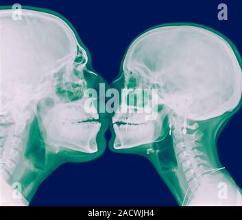 Kissing Couple. Two people kissing under x-ray Stock Photo