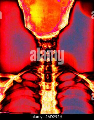 Neck vertebrae and skull. Coloured X-ray of the bones of the neck, skull and upper chest, seen from the front. The ribs and clavicles (collar bones) a Stock Photo