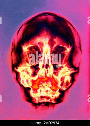 Skull. Coloured X-ray of the bones of a human skull, seen from the front. The skull consists of the lower jaw bone (mandible) and the cranium. The cra Stock Photo