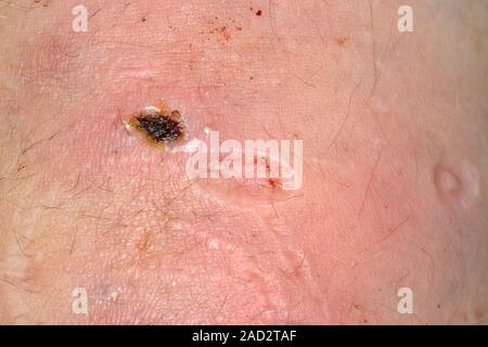 Cigarette burn scars in self-harm. Close-up of infected scars from cigarette  burns on the arm of a 36-year-old male patient with a history of self-har  Stock Photo
