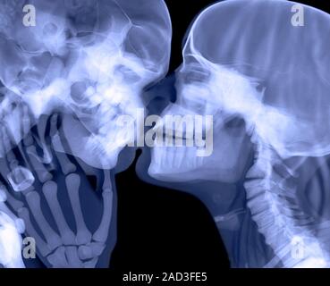Lovers kissing, X-ray. The X-ray has revealed the bones of their heads and the teeth in their mouths, as well as the vertebrae of the woman's neck and Stock Photo