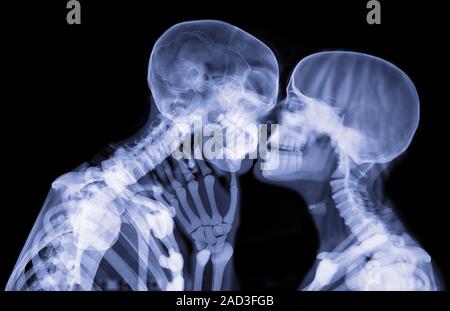 Lovers kissing, X-ray. The X-ray has revealed the bones of their heads and the teeth in their mouths, as well as the vertebrae of their necks and the Stock Photo