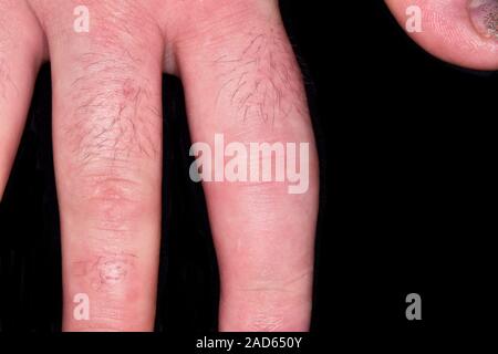 Broken finger. Close-up of the finger of a 29-year-old female patient with a comminuted fracture after trapping it in the door of a commercial dishwas Stock Photo