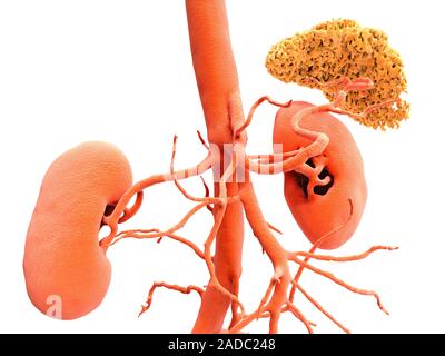 Kidneys, CT scan. Coloured 3-D computed tomography (CT) scan of kidneys in frontal view. The image shows the abdominal aorta (top centre to bottom) wh Stock Photo