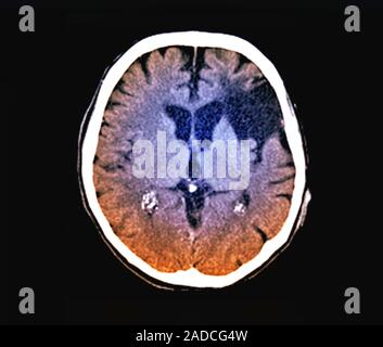 Stroke brain damage. Coloured axial computed tomography (CT