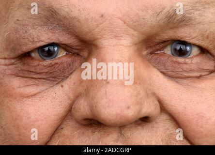 Not for use in Television Not for use in Television Arcus senilis iris disorder. Eyes of an elderly man with bilateral arcus senilis and darkened lowe Stock Photo