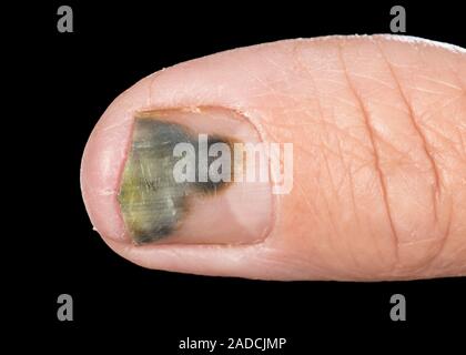 150+ Paronychia Stock Photos, Pictures & Royalty-Free Images - iStock |  Stomatitis, Ingrown nail, Impetigo