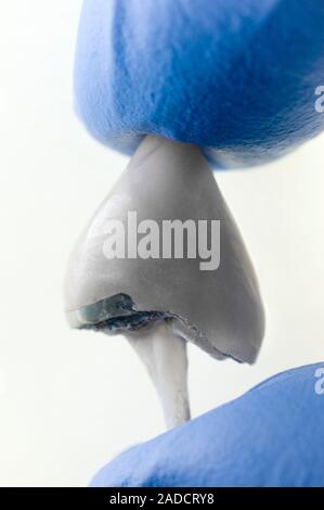 A fused metal dental porcelain crown, fitted with a fibre post. The picture shows the metal base fused to a false porcelain tooth that became detached Stock Photo