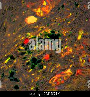 Nanoparticles in pancreatic cancer. Light micrograph of magnetic iron nanoparticles being used to target specific receptors on pancreatic cancer cells Stock Photo