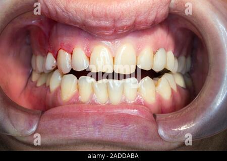 Open bite. Close-up of the mouth of a patient with an open bite. Open bite is a form of malocclusion, a misalignment between the teeth of the upper an Stock Photo