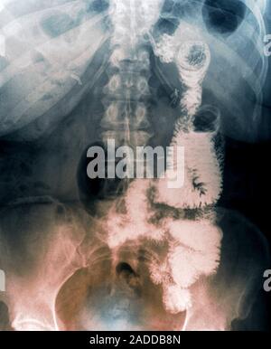 Gastric bypass. Coloured frontal X-ray of the digestive system of an obese 52-year-old woman (weighing 145 kilograms) who has had a gastric bypass for Stock Photo