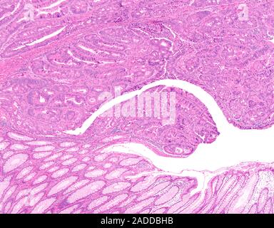 Colon cancer in a polyp, light micrograph. Adenocarcinoma is a cancer of the glandular lining that is found in many different organs, including the di Stock Photo