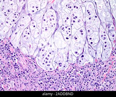 Signet ring cell carcinoma of the colon, light micrograph. This is a rare form of adenocarcinoma, a cancer of the glandular lining that is found in ma Stock Photo