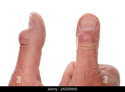 A digital myxoid cyst (sometimes called a mucous cyst) is a benign swelling that occurs on the fingers or, sometimes, the toes. Digital myxoid cysts a Stock Photo