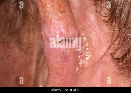 MODEL RELEASED. Scar after basal cell carcinoma excision from the pinna area of the ear of a 76-year-old man. Basal cell carcinoma is one of the most Stock Photo