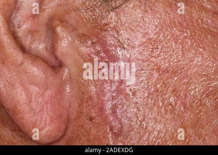 MODEL RELEASED. Scar after basal cell carcinoma excision from near the ear of a 76-year-old man. Basal cell carcinoma is one of the most common forms Stock Photo