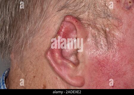 MODEL RELEASED. Deformed ear after basal cell carcinoma excision from the pinna area in an 88-year-old man. Basal cell carcinoma is one of the most co Stock Photo