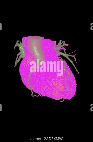 Coronary artery disease. Coloured 3D computed tomography (CT) scan showing atherosclerosis of a coronary artery of the heart in a patient with coronar Stock Photo