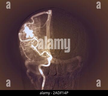 Cerebral arteriovenous malformation. Frontal X-ray of the skull and brain of a 32-year-old woman who has an arteriovenous malformation (AVM, upper lef Stock Photo