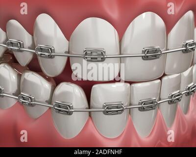 Illustration showing dental braces on straight teeth. 3D illustration. Stock Photo