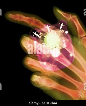Stopwatch. Coloured X-ray of a hand holding a stopwatch. The thumb is pressing a button that will accurately stop or start the watch. The electronics Stock Photo