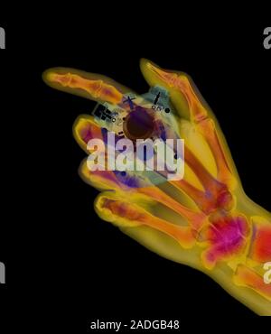 Stopwatch. Coloured X-ray of a hand holding a stopwatch. The thumb is pressing a button that will accurately stop or start the watch. The electronics Stock Photo